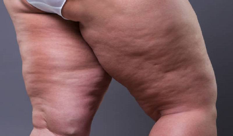 Tienes mucha grasa acumulada en piernas y brazos? Podrías padecer de lipedema en lugar de obesidad | Salud | La Revista El Universo