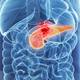 ¿Dónde duele el cáncer de páncreas? Síntomas tempranos que se manifiestan en heces y orina