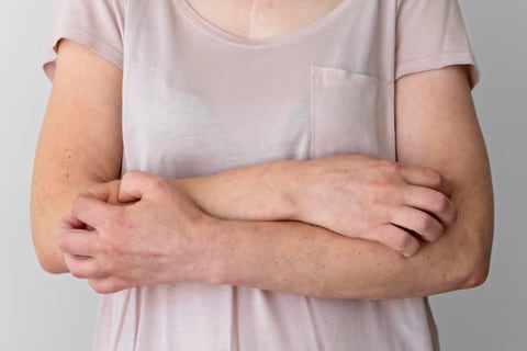 Estas son las manifestaciones del estrés en la piel que se pueden confundir con un ataque de alergia
