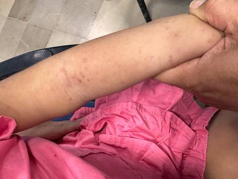 Casos de sarna superan los 2.657 infectados en Guayaquil, Durán y Samborondón: ¿cómo evitar contagiarme?