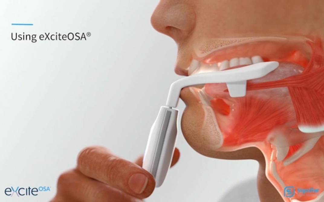 La FDA aprobó un nuevo dispositivo para el tratamiento de la apnea
