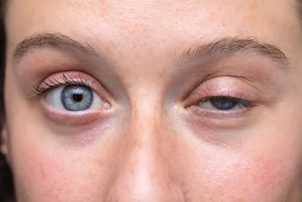El 'ojo torcido' de Katy Perry tiene una explicación médica; la artista  podría estar pasando por un blefaroespasmo | Gente | Entretenimiento | El  Universo