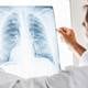 Estas son las principales causas del cáncer de pulmón según especialistas
