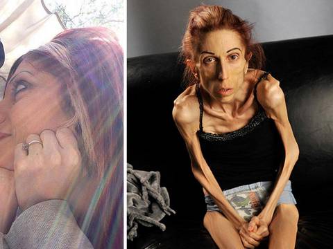 Rachael Farrokh sufre anorexia y pide ayuda en internet para salvar su vida