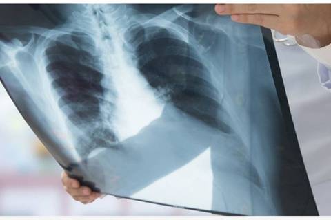 Cáncer de pulmón y mama son los más comunes en el mundo, alerta la Organización Mundial de la Salud