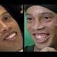 Ronaldinho aseguró estar "feliz" con su nueva dentadura