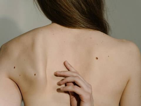 Estos son los primeros síntomas del cáncer de piel: ¿conoce la regla ABCDE para detectar el melanoma?