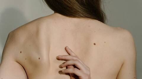 Estos son los primeros síntomas del cáncer de piel: ¿conoce la regla ABCDE para detectar el melanoma?