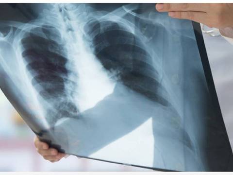 Cáncer de pulmón y mama son los más comunes en el mundo, alerta la Organización Mundial de la Salud