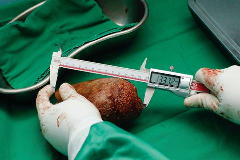 Anuncian en Sri Lanka que extirparon un cálculo renal que pesaba casi 2 libras y quedó registrado como récord mundial