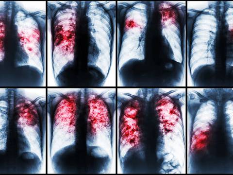 La pandemia del Covid-19 amenaza la lucha contra la tuberculosis