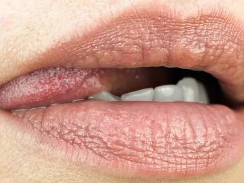 Las enfermedades que pueden transmitirse durante el sexo oral sin preservativo y cómo protegerte