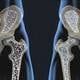 Preguntas y respuestas sobre la osteoporosis