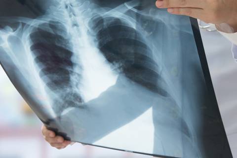Síntomas iniciales que podrían alertar sobre la presencia de cáncer de pulmón