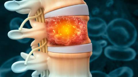Los dolores en estas tres diferentes partes del cuerpo podrían avisar un cáncer espinal