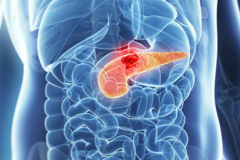 ¿Dónde duele el cáncer de páncreas? Síntomas tempranos que se manifiestan en heces y orina