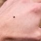 Cómo un pequeño insecto pone en jaque tu sistema inmune: las 3 amenazas que esconden las garrapatas este verano