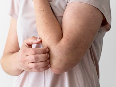 Detectan casos de sarampión en centro migratorio de Dilley, Texas