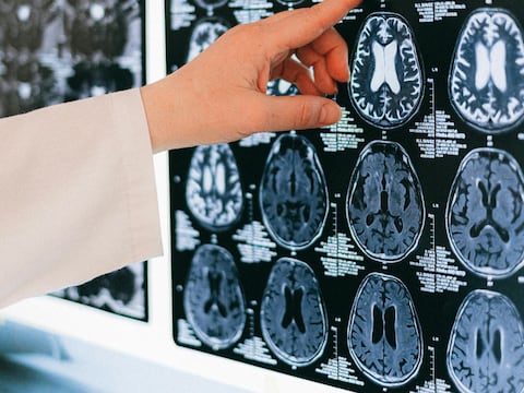 ¿Quiénes tienen más riesgo de sufrir un accidente cerebrovascular? El perfil clínico que debes conocer
