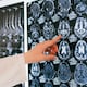 ¿Quiénes tienen más riesgo de sufrir un accidente cerebrovascular? El perfil clínico que debes conocer