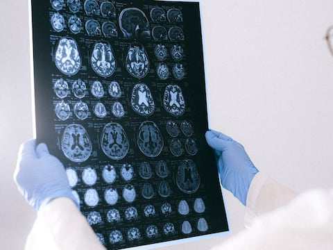 IA ayuda a precisar tratamiento psiquiátrico: Científicos descubren patrón neuronal de la esquizofrenia y el trastorno bipolar