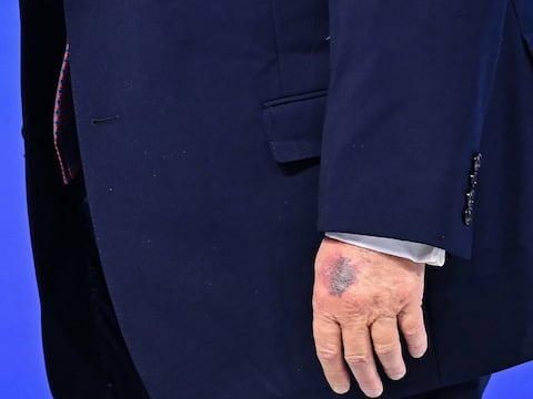 Donald Trump atribuye moretones en su mano a golpe contra la mesa