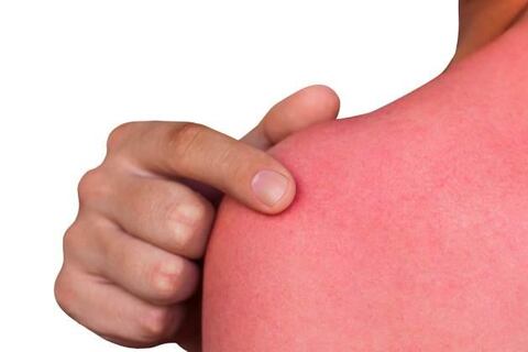 Tras pasar ocho horas al sol mujer sufre quemaduras graves de tercer grado en las piernas por un olvido imperdonable