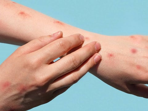 ¿Cuáles son los síntomas de la viruela símica detectada en Ecuador?