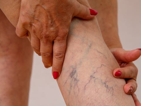 Vitaminas para las várices: mejoran las funciones del sistema circulatorio y previenen enfermedades