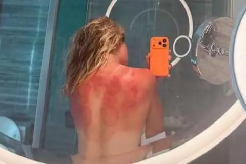 “El sol de Australia no es broma”: la foto de una tenista mexicana que muestra el riesgo en el país con las tasas de cáncer de piel más altas del mundo